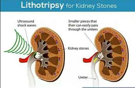 Cost Of Lithotripsy Eswl In Nigeria Including Abuja And Lagos Nigerian Health Blog