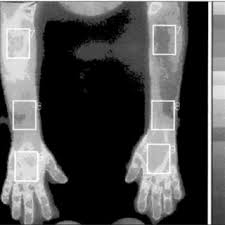 Complex Regional Pain Syndrome M 16 This Picture Shows The Download Scientific Diagram