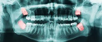 Here's what to know and some strategies to help you after she brushed her teeth. Managing Wisdom Tooth Pain At Home Without Seeing A Dentist