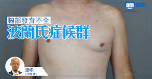 罹患此症的小孩，臉上常有 笑容 ，缺乏語言能力、 過動 ，且 智能低下 。. Facebook
