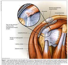 Managing Partial Thickness Rotator Cuff Tears 10 Clinical Pearls Differentiating Between Partial And Full Thickness Lesions Is Critical Document Gale Onefile Health And Medicine