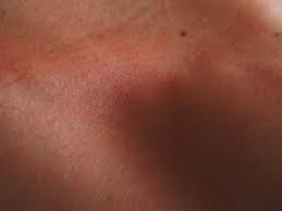 Conoce cuáles son las principales características y cómo tratarla. Culebrilla Enfermedad Que Brota Con El Estres Es Contagiosa