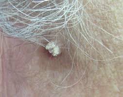 Image result for verrucae filiformes