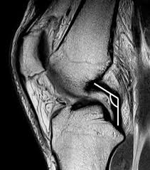 Image result for PCL Sulcus Test