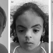 Histology of the endometrial cancer. A. Moderately differentiated...