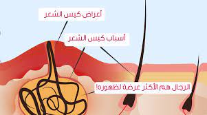 كيس الشعر أسباب وأعراض وعلاج ويب طب