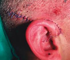 Heridas y Cicatrización