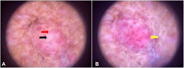 Image result for Merkel Cell Carcinoma
