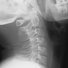 Скрытый спинальный дизрафизм (spina bifida occulta). Spina Bifida Occulta Cervical Spine Image Radiopaedia Org