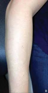 Image result for pruritic urticarial papules and plaques of pregnancy