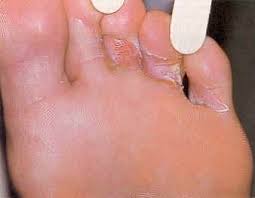 There are various home remedies for dealing with foot fungus. 46 Athletes Foot Ideas Ø§Ù„Ù‚ÙˆØ© Ø§Ù„Ù†Ø§Ø¹Ù…Ø© Ø·Ø¨ Ù†Ø¨Ø§ØªØ§Øª Ø·Ø¨ÙŠØ©