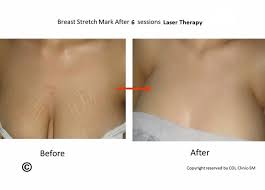 How To Get Rid Of Stretch Marks On Breasts After Pregnancy Anti Stretch Marks Firming Confront Cream