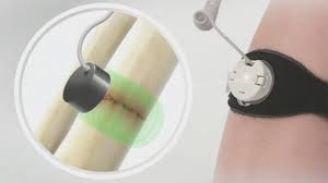 Bioventus Announces U S Debut Of Feature Rich New Exogen Device Business Wire