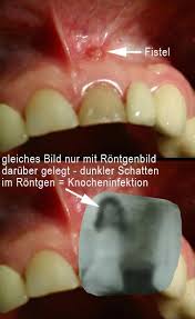 Eine Zahn Fistel Gehort Behandelt Z B Durch Eine Fistel Op Und Nicht Belassen Dentalnews