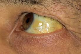 Jaundice in adults | healthdirect