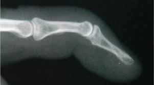 Xray of boutounneire deformity (schwartz). Mallet Finger Baseball Finger