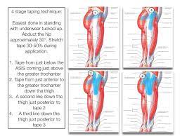 Hip Flexor Stretches Gluteal Tendinopathy Hip Workout Kinesiology Taping Bursitis Hip
