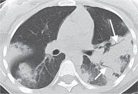 Image result for Air Bronchogram