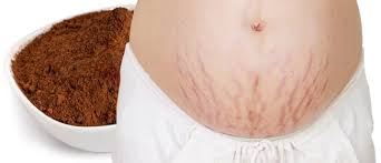 Tak semua wanita memiliki kulit payudara yang mulus. Agar Stretch Mark Hilang Perlahan Jangan Lupa 8 Cara Ini Diterapkan