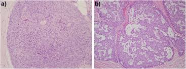 Charlotte a 17 ans streaming version française sans illimité en qualité hd 720p, full hd 1080p, 4k. Solid Papillary Dcis Patterns A Streaming Growth Pattern B Download Scientific Diagram