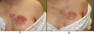 Image result for zoster under breasts