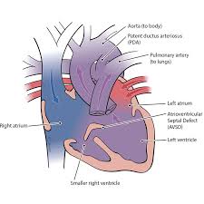 Image result for Endocardial Cushion Defect