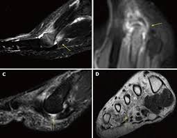 Trauma effects of direct injury or tear denervation injury: Role Of Imaging Methods In Diagnosis And Treatment Of Morton S Neuroma