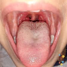 Image result for Strep throat infection roof of mouth