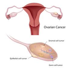 ▪ what is ovarian cancer? Ovarian Cancer Symptoms And Causes I Fashion Styles