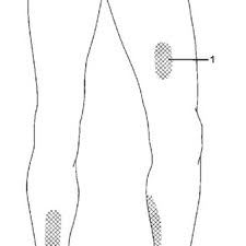 We did not find results for: Pdf Martorell S Hypertensive Leg Ulcer Case Report And Concise Review Of The Literature