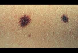 These extra cells may form a mass of tissue, called a tumor. Moles 3 Basic Types Causes Symptoms Removal