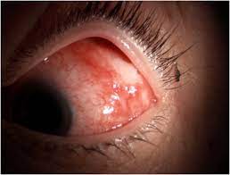 Isolated Conjunctival Granuloma As A First Manifestation Of Parinaud S Oculoglandular Syndrome A Case Report Sciencedirect