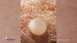 What Is a Milk Blister - Bleb - Mumsy Natural