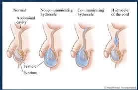 According to the testicular cancer society: Testicular And Urethral Disorders Flashcards Quizlet