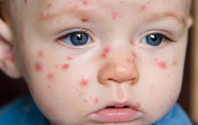 Resultado de imagen de varicela