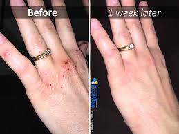 Angie S Struggle With Hand Eczema Eczemate Com Eczema On Hands Hand Dermatitis Eczema Symptoms