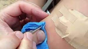 Bot fly removal july 14, 2009. Removing Botfly Larvae From Under Human Skin Youtube