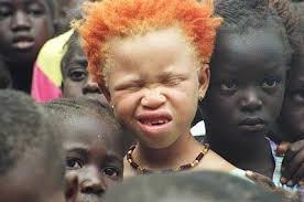 Black Hair And Ginger Hair Baby Beautiful Albino African American Child With The Most Fabulous Red Hair Beautiful Children Albinism Face