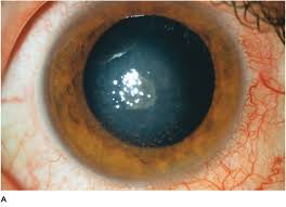 Hsv infection can cause inflammation in nearly every ocular tissue. Corneal Infections Inflammations And Surface Disorders Ento Key