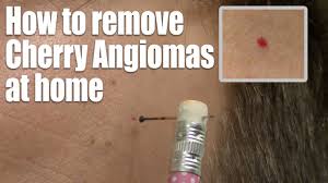 Symptoms, pictures, causes, prevention methods, treatment, removal. How To Remove Red Skin Dots At Home Quick Easy Cherry Angioma Treatment Youtube