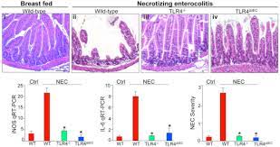 Ptosis is a rare complication of periocular steroid use. Necrotizing Enterocolitis Pathophysiology From A Historical Context Sciencedirect