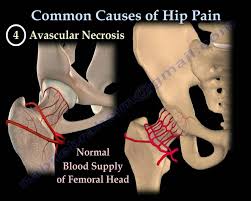 Read about hip pain in adults, including the possible causes, when to get medical advice, and how to manage it at home. Hip Pain Common Causes Everything You Need To Know Dr Nabil Ebraheim Youtube