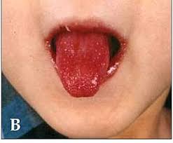 En efecto, lo que comúnmente se llama «gasto de los hogares», representa las 2/3 partes del pib. Kawasaki Disease Wikipedia