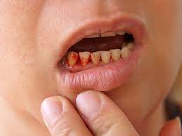 16 Ways To Get Rid Of Canker Sores