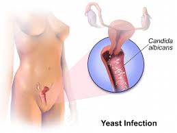 Image result for Candidiasis
