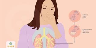 Sebenarnya punca paru paru berair masih tidak dapat dikenalpasti dengan tepat. Pneumonia Tanda Dan Gejala Penyebab Cara Mengobati Cara Mencegah