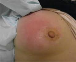 After getting vaccinated, most people report mild to moderate side effects within three these side effects should last for only a day or two but may affect your ability to do daily activities such as going to work or hitting the gym. Mastitis Wikem