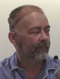 Médicos estadounidenses realizan el primer trasplante mundial de cráneo