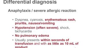 Image result for Transfusion Associated Circulatory Overload