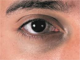 Image result for nevus sclerae